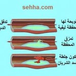 الجلطات الدماغية وعلاجها عبر برنامج غذائي في المنزل د.باسل الجاسم