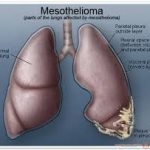 اندر مرض سرطانى (mesothelioma) والوقاية منه